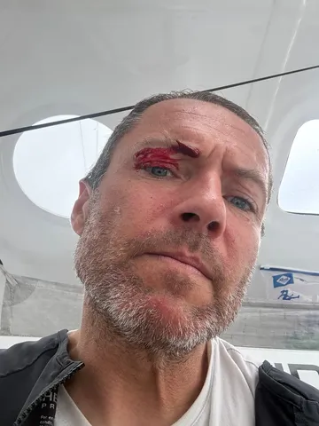 COURSE, 02 DÉCEMBRE 2024 : Photo envoyée depuis le bateau Fortinet - Best Western lors de la course à la voile du Vendée Globe le 02 décembre 2024. (Photo du skipper Romain Attanasio) Blessure